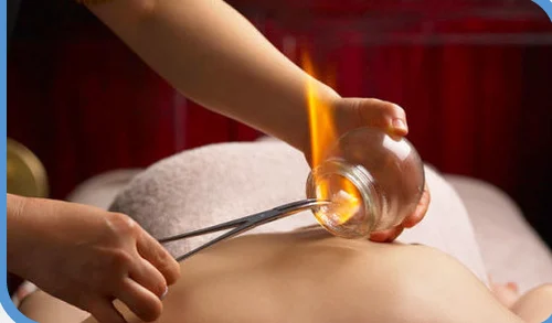 Fire Cupping