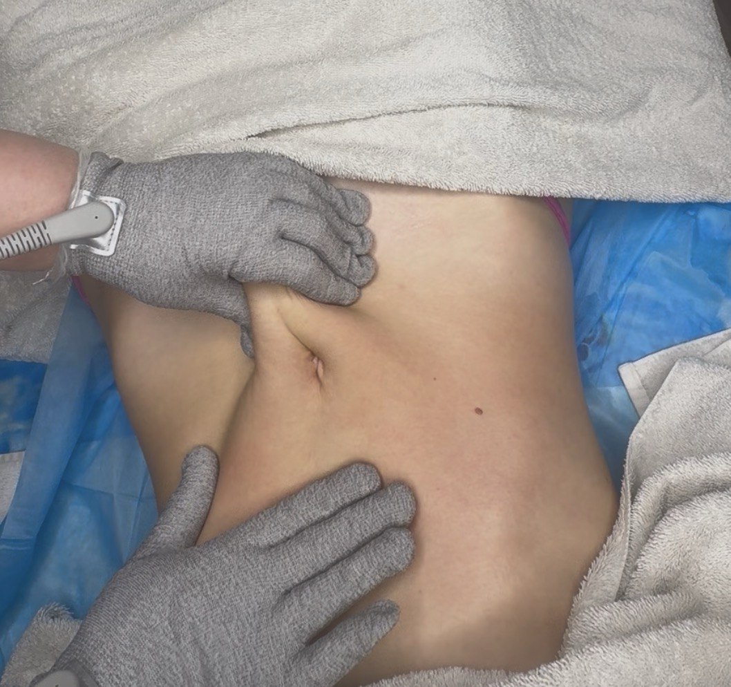 Premium Belly & Internal Organ Lift